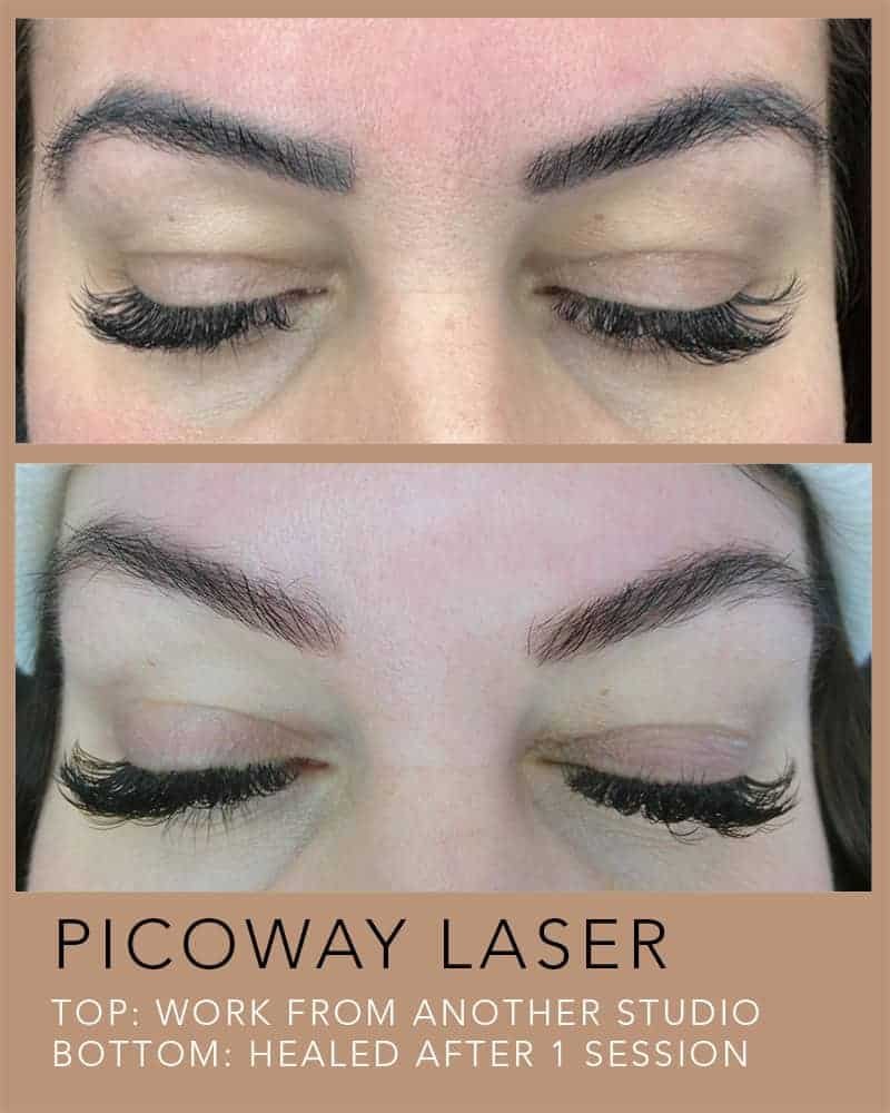 PICOWAY-LASER