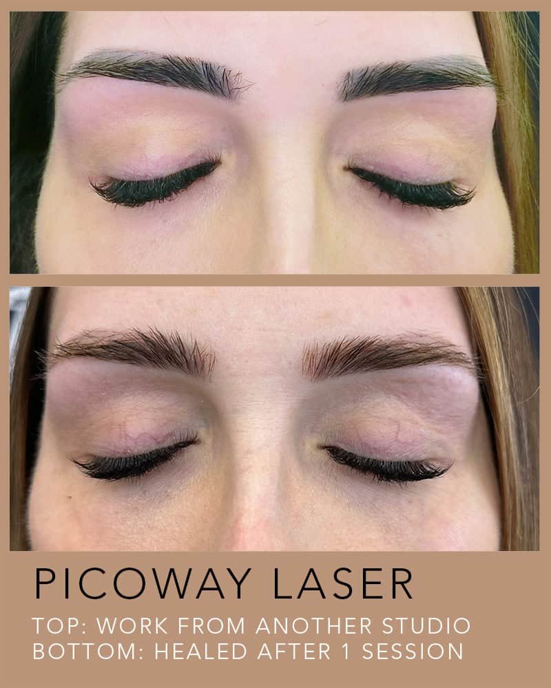 PICOWAY-LASER-TATTOO-REMOVAL