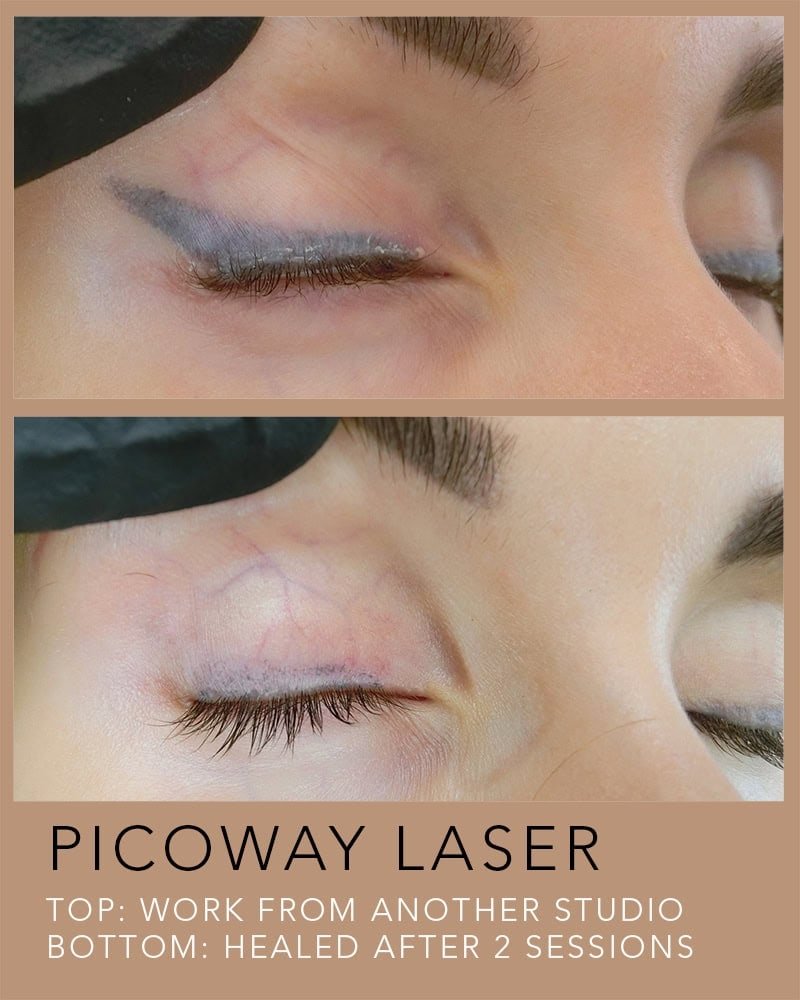 PICOWAY-LASER-TATTOO-REMOVAL