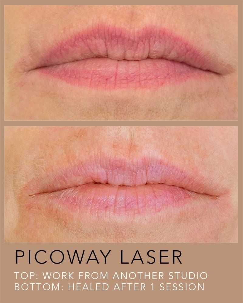 PICOWAY-LASER-TATTOO-REMOVAL