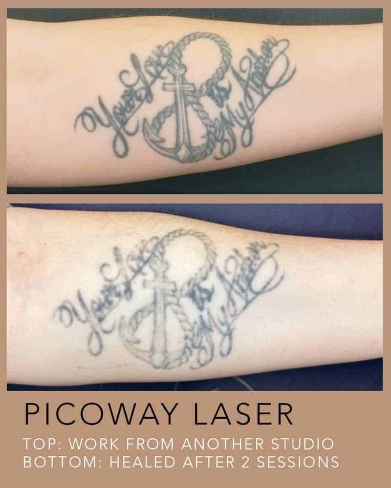 PICOWAY-LASER-TATTOO-REMOVAL-7