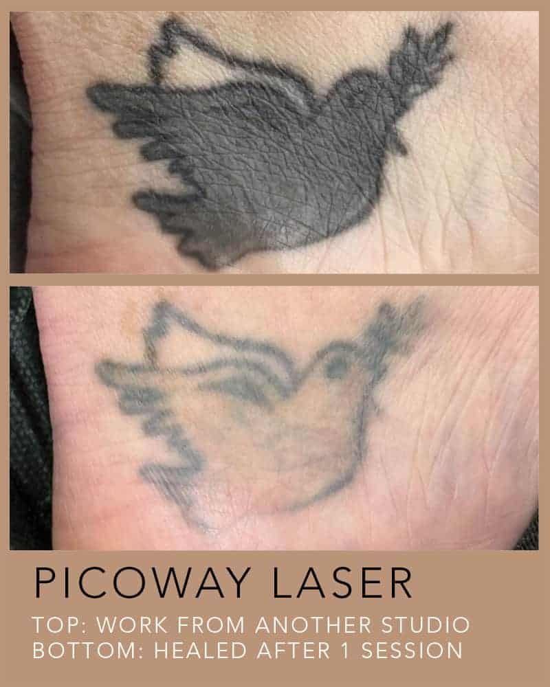 PICOWAY-LASER-TATTOO-REMOVAL-8