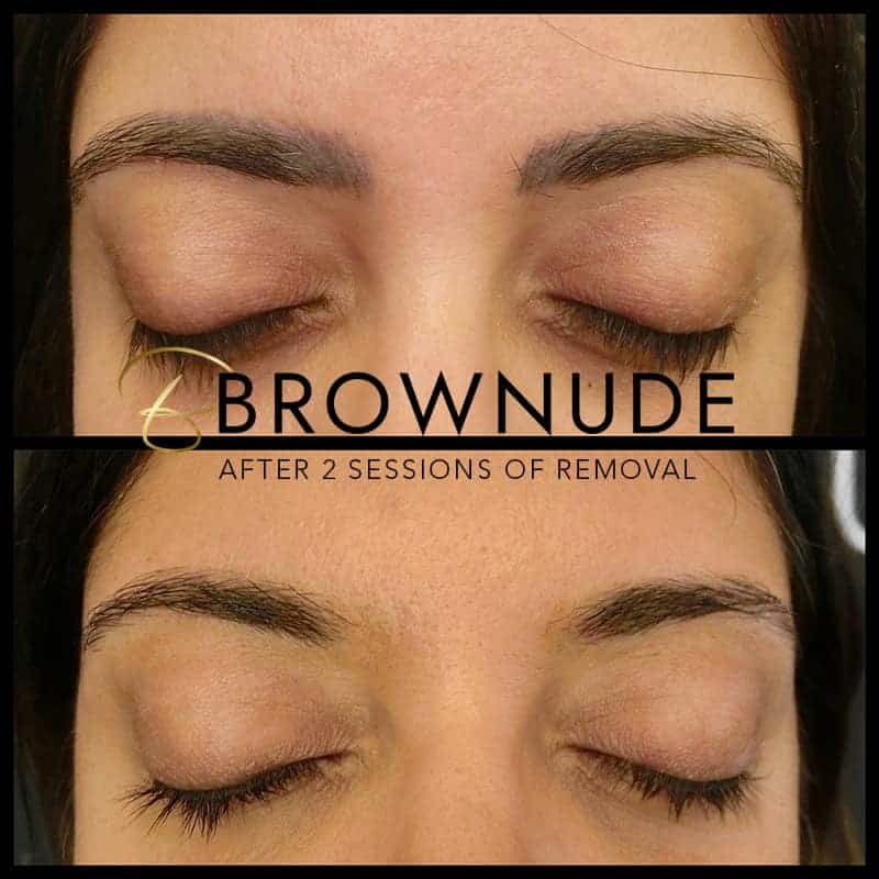 Brow-Picoway-Laser-Removal-Brownude