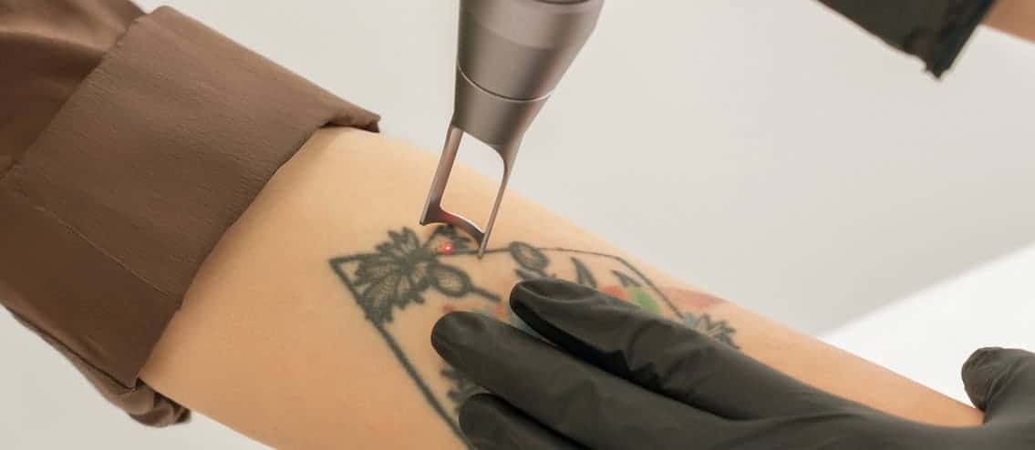 Laser-Cosmetic-Tattoo-Permanent-Makeup-Removal