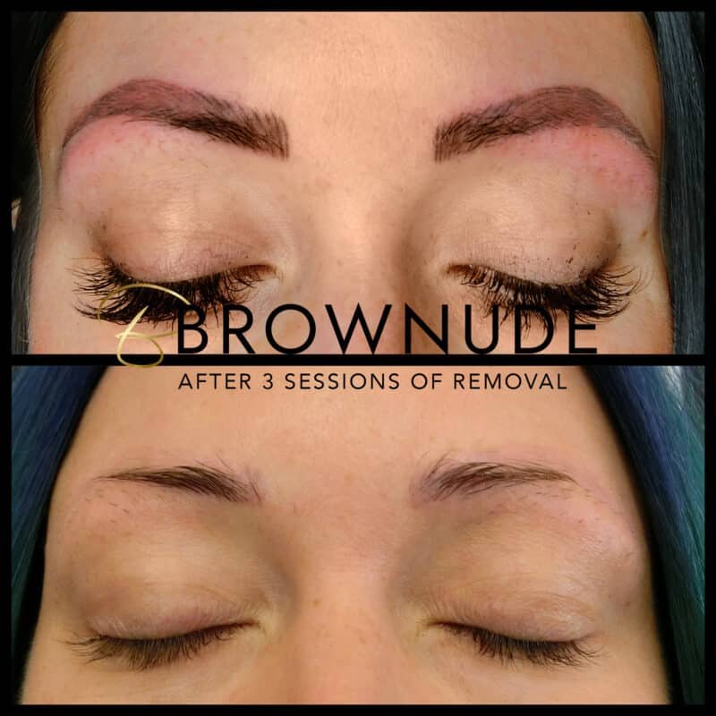 Saline-Tattoo-Removal-Brownude-Edmonton-vancouver