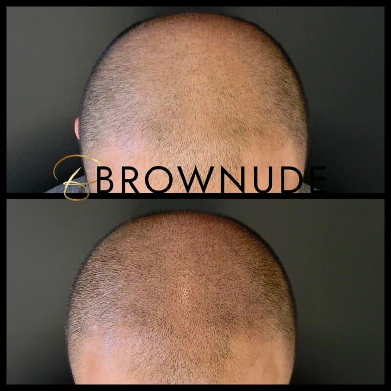 Scalp-Micropigmentation-Tattoo-Brownu