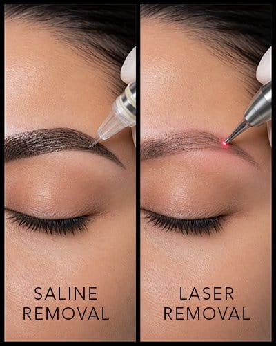 Eyebrow treatment before and after saline and laser removal techniques.