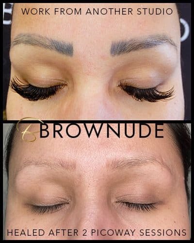 Eyebrow tattoo removal results showing healed skin after sessions.