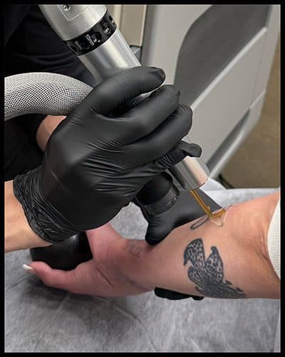 Medical professional performing PicoWay laser treatment on patient's hand.