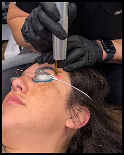Pico laser tattoo removal treatment on a woman's face at Brownude clinic.
