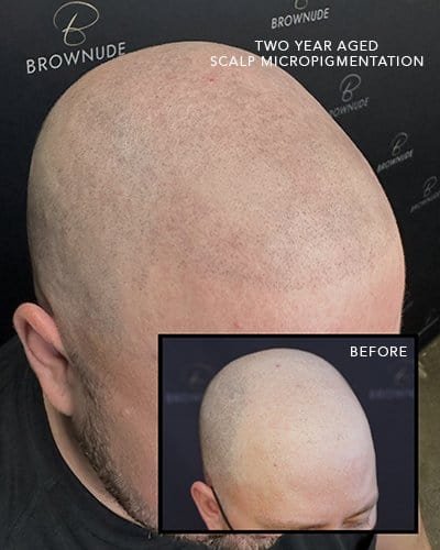 Close-up of scalp micro pigmentation on a bald man, showing natural hair follicle details.