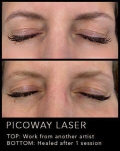 Before and after PicoWay eyebrow removal treatment comparison.