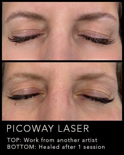 Before and after PicoWay eyebrow removal treatment comparison.