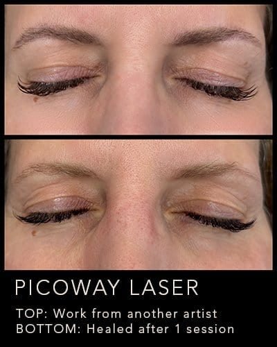 Before and after PicoWay eyebrow removal treatment comparison.
